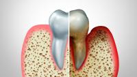 Tooth comparing healthy gums and diseased, inflamed gums